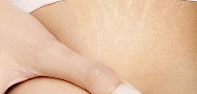 صورة جديد أسباب ظهور علامات تمدد الجلد