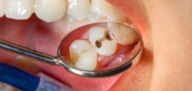 603858dd4a396 جديد أسباب نخر الأسنان