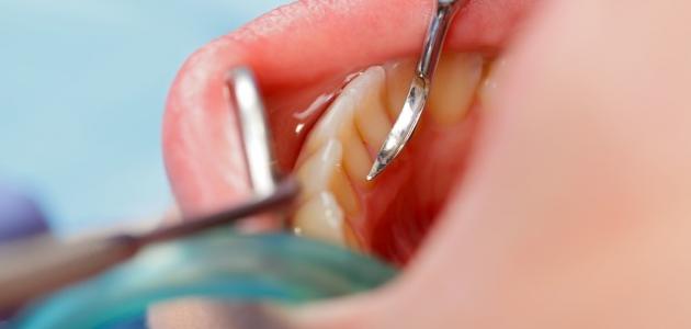 صورة جديد أضرار تنظيف الأسنان عند الطبيب