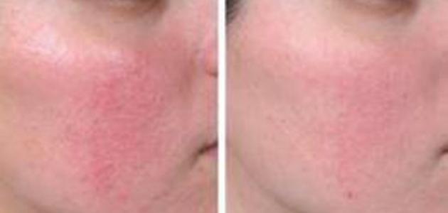 603e3ef10610d جديد كيفية علاج احمرار الوجه