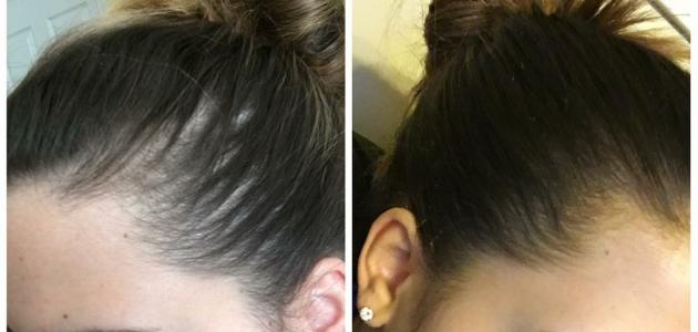 صورة جديد كيفية إيقاف تساقط الشعر للنساء