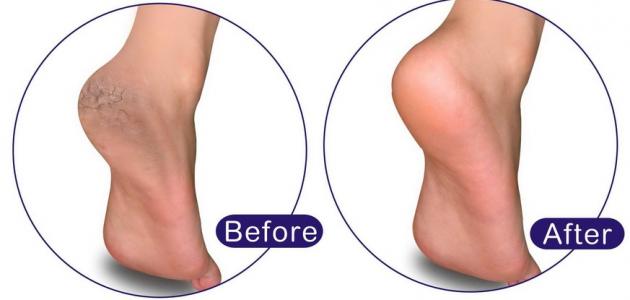 60490a6841fcb جديد كيفية إزالة الجلد الميت من القدمين