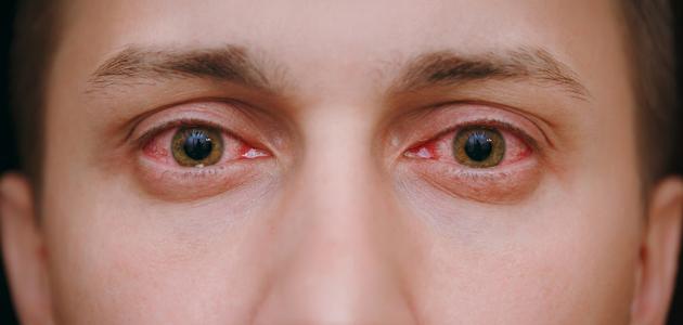 صورة جديد أمراض قزحية العين