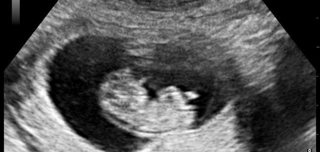 صورة جديد متى تظهر تشوهات الجنين
