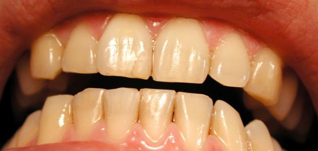 صورة جديد ما سبب اصفرار الأسنان