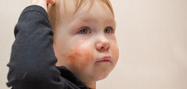 صورة جديد علاج الطفح الجلدي عند الأطفال