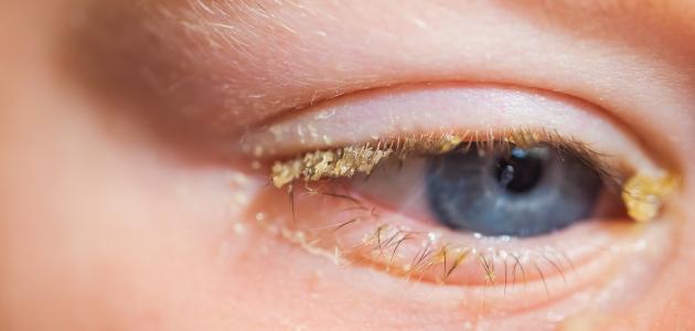 صورة جديد علاج رمد العين للأطفال