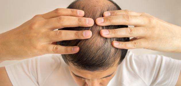 صورة جديد ما علاج تساقط الشعر عند الرجال