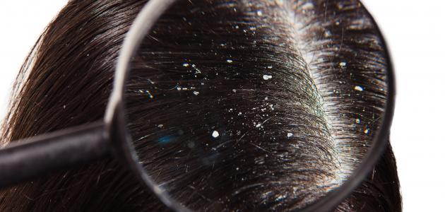 صورة جديد ما هو أفضل علاج لقشرة الشعر