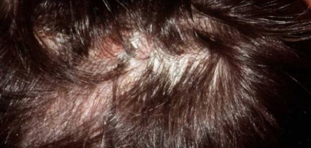 صورة أعراض التهاب بصيلات الشعر وعلاجه