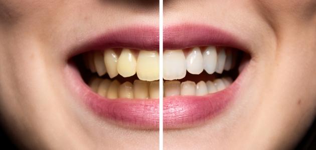 صورة كيفية جعل الأسنان بيضاء