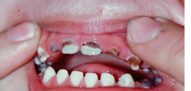 607a841f96b0f مراحل تسوس الأسنان