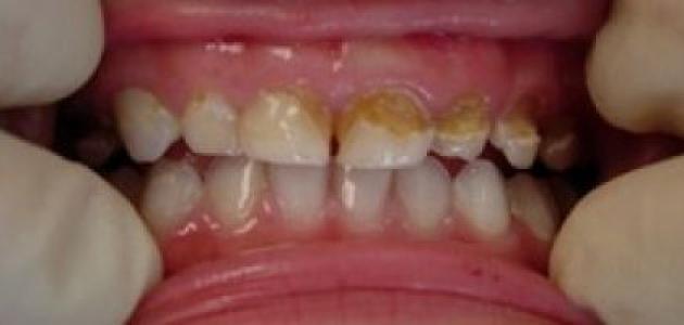 صورة علاج تسوس الأسنان عند الأطفال