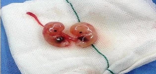 صورة كيف يمكن إسقاط الجنين