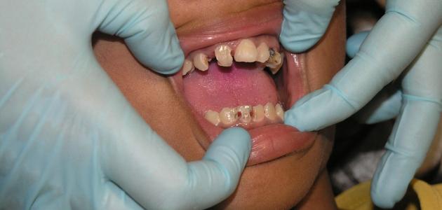 6082e5f5bc88b علاج تسوس الأسنان الأمامية