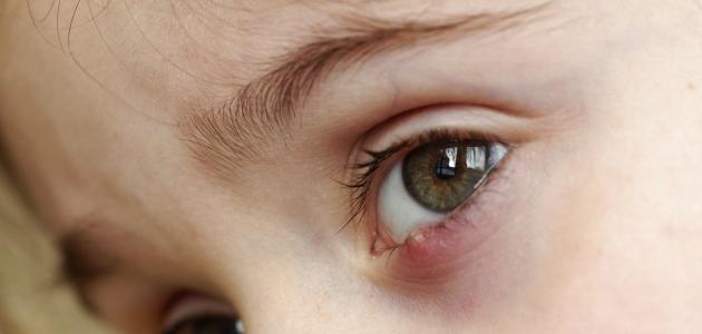صورة التهاب العين للأطفال