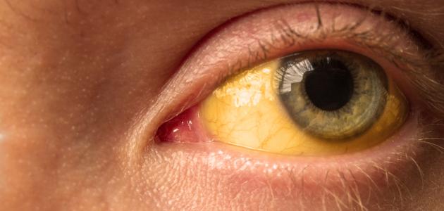 صورة علاج صفار العين