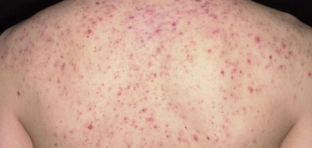 آثار حب الشباب بالظهر آثار حب الشباب بالظهر