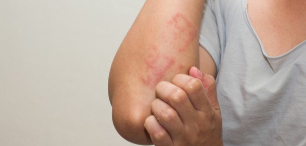 أسباب الطفح الجلدي المفاجئ عند الكبار