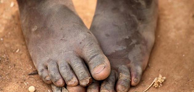 أسباب الفقر وعلاجه أسباب الفقر وعلاجه