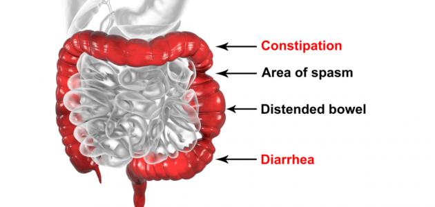 أسباب القولون العصبي