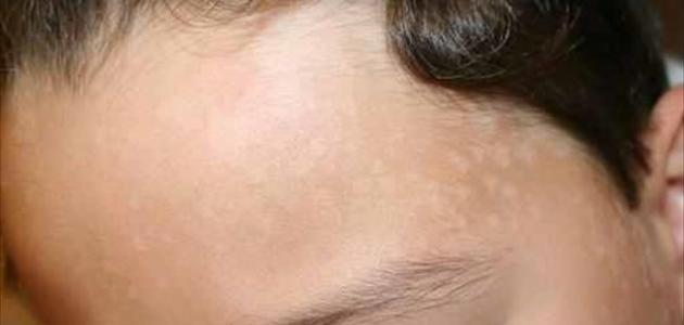 أسباب بقع الوجه أسباب بقع الوجه