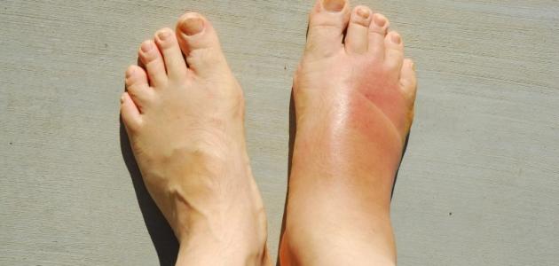 أسباب تورم القدمين