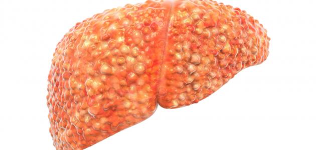 أسباب زيادة إنزيمات الكبد أسباب زيادة إنزيمات الكبد