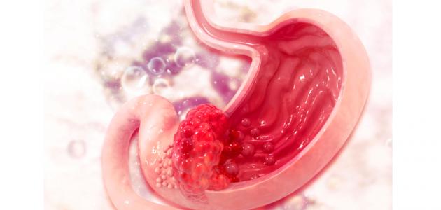 أسباب سرطان المعدة أسباب سرطان المعدة