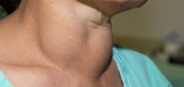 أسباب فرط الغدة الدرقية أسباب فرط الغدة الدرقية