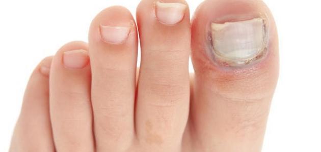 أسباب فطريات الأظافر
