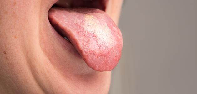 أسباب فطريات الفم المتكررة أسباب فطريات الفم المتكررة