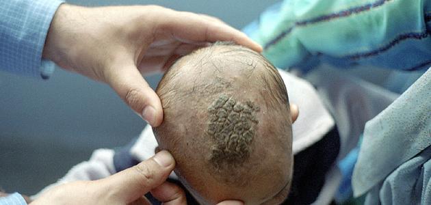 أسباب فطريات فروة الرأس أسباب فطريات فروة الرأس