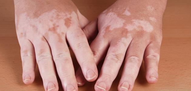 أسباب مرض البهاق أسباب مرض البهاق