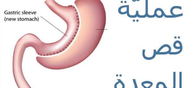 أضرار عملية قص المعدة أضرار عملية قص المعدة