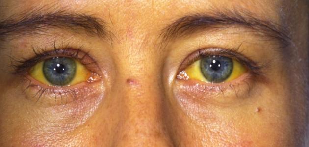 أعراض التهاب الكبد الوبائي ب أعراض التهاب الكبد الوبائي ب