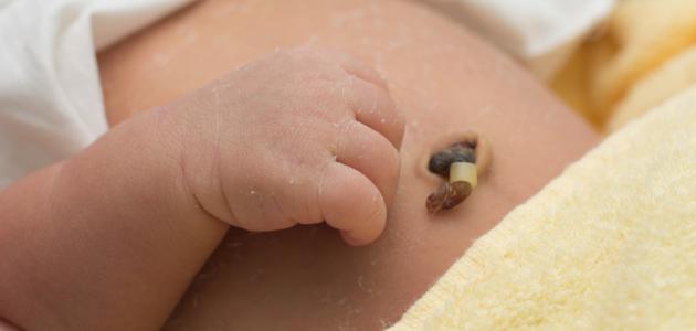 أعراض التهاب سرة المولود أعراض التهاب سرة المولود