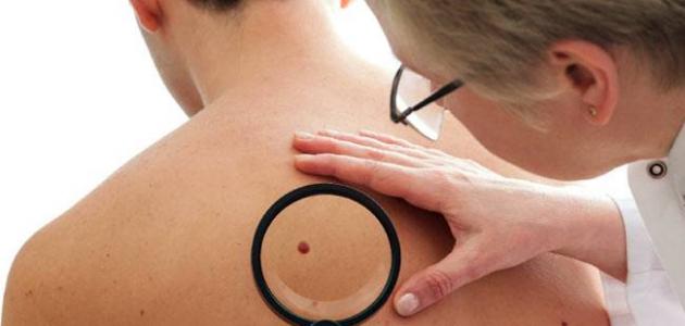 أعراض السرطان بشكل عام أعراض السرطان بشكل عام