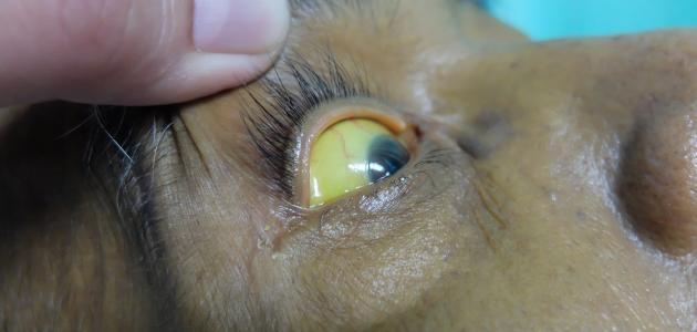 أعراض بوصفير أعراض بوصفير