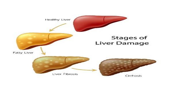 أعراض تشمع الكبد أعراض تشمع الكبد
