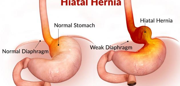 أعراض فتق الحجاب الحاجز أعراض فتق الحجاب الحاجز