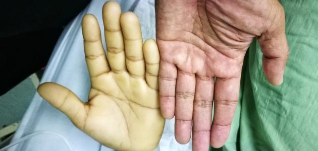 أعراض فقر الدم أعراض فقر الدم