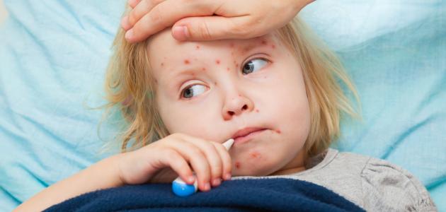 أعراض مرض الحصبة أعراض مرض الحصبة