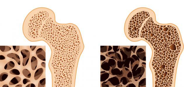 أعراض هشاشة العظام عند النساء أعراض هشاشة العظام عند النساء