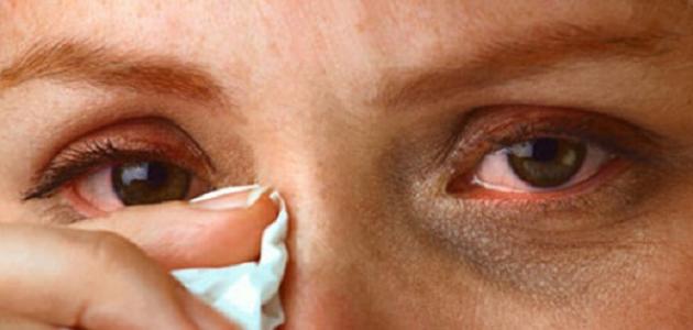 أعراض وأسباب الرمد الربيعي - فيديو أعراض وأسباب الرمد الربيعي - فيديو