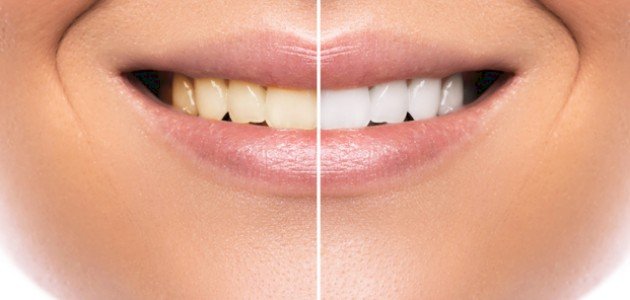 أفضل طريقة لتبيض الأسنان أفضل طريقة لتبيض الأسنان