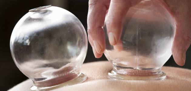 أفضل وقت للحجامة