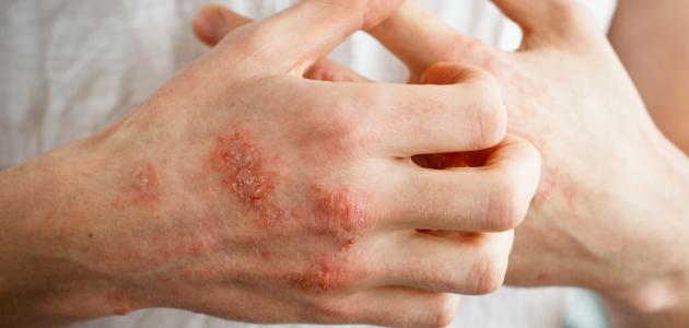 أمراض تشبه الصدفية أمراض تشبه الصدفية