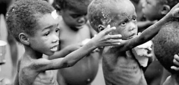 أمراض ناتجة عن سوء التغذية أمراض ناتجة عن سوء التغذية