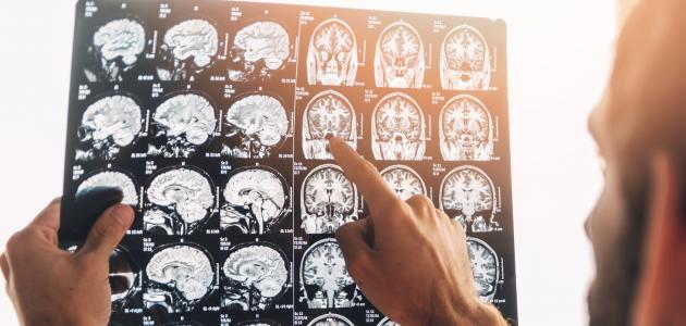 أنواع إصابات الرأس